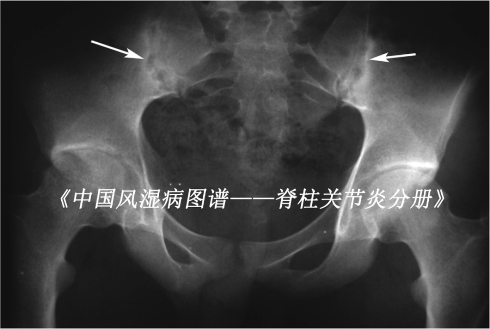 书中的彩图张张精彩; 强直性脊柱炎患者,图为x线片示骶髂关节炎Ⅳ级