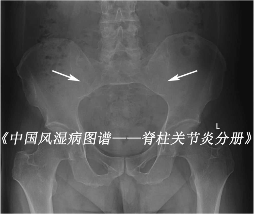 强直性脊柱炎患者,图为x线片示骶髂关节炎Ⅲ级(箭头处).
