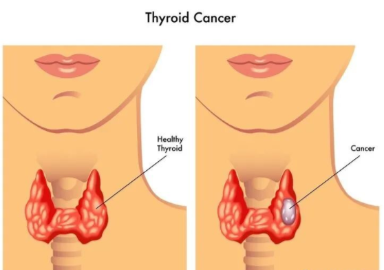 淋巴结肿大:部分甲状腺癌患者会出现淋巴结肿大,在排出其他器质性病变