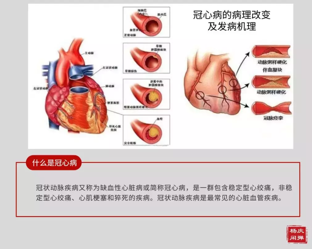 得了冠心病需要注意什么问题?冠心病可以治好吗?