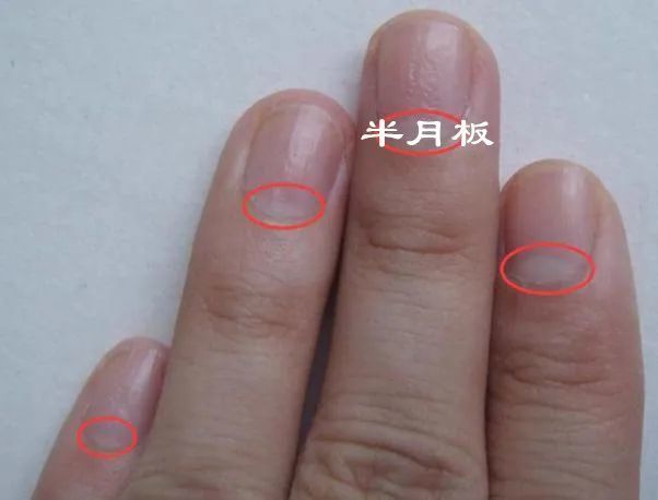 高血脂状况从手掌就能看出来这个实用方法你需要知道