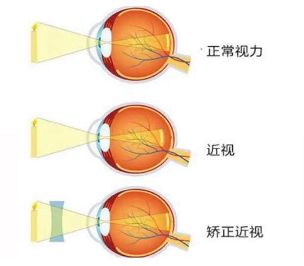 "近视眼"学生不能报考的五大专业,学生注意了