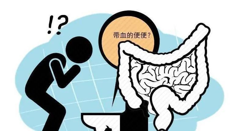 如果遇上这些情况,警惕肠癌已经找上你