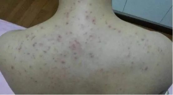 "经常使用粗糙的搓澡巾搓澡,把皮肤搓红,搓痛了,对皮肤屏障是一种