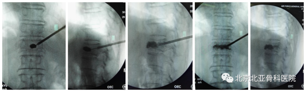 中老年脊柱骨折微创经皮椎体成型术了pkppvp