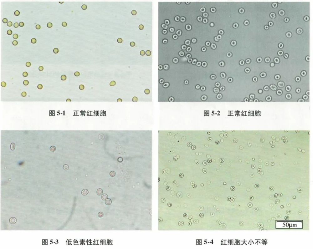 一文读懂尿液红细胞形态分析