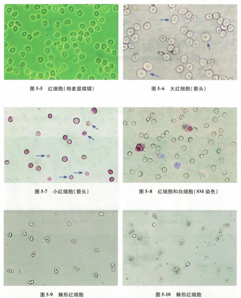 一文读懂尿液红细胞形态分析