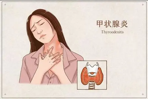 甲状腺王克珍主任:患有亚急性甲状腺炎,做好这3件事,你一定要了解!