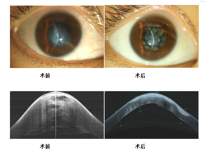 2. 稳定期行穿透性角膜移植术以提高视力水平.