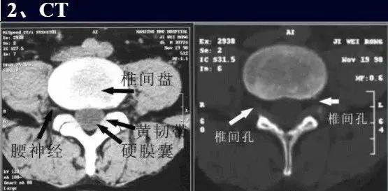 椎间盘膨出,突出,脱出如何鉴别,几幅图让你一目了然