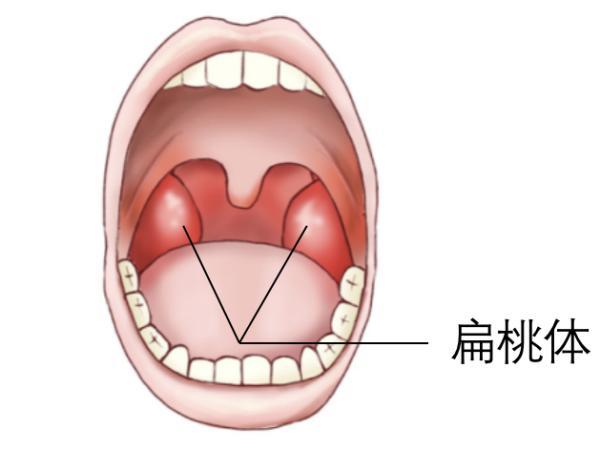 原因是上呼吸道的淋巴肥大,主要指腺样体肥大和扁桃体肥大(如下图)