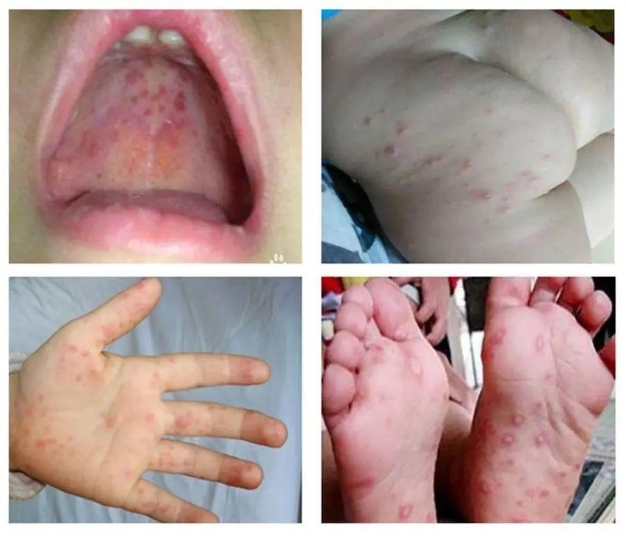 得了手足口病后会怎样? 手,足和臀部出现皮疹或疱疹,口腔内出现疱疹.