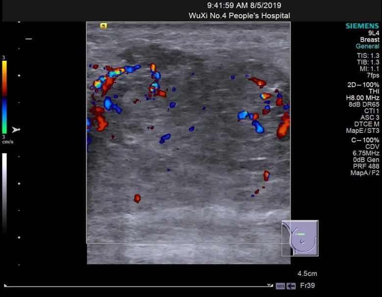 可能你见过一些乳腺管状腺瘤的超声表现,但这些病例真的不一样!