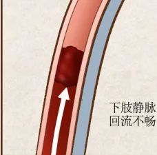 经过血管外科会诊,为了避免栓子脱落后严重并发症,小张接受了下腔静脉