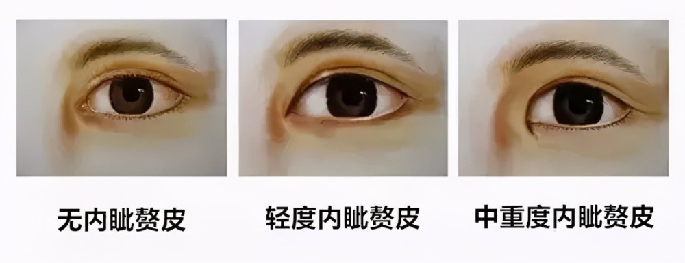 做了埋线,眼角与重睑线交连处产生分叉.