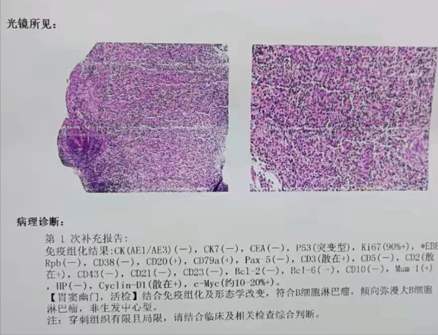 伪装成胃溃疡的胃恶性淋巴瘤究竟是怎么回事?专家带你