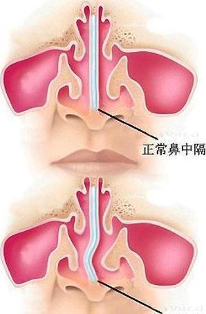 鼻炎反复不愈,竟可能是鼻中隔偏曲搞的鬼