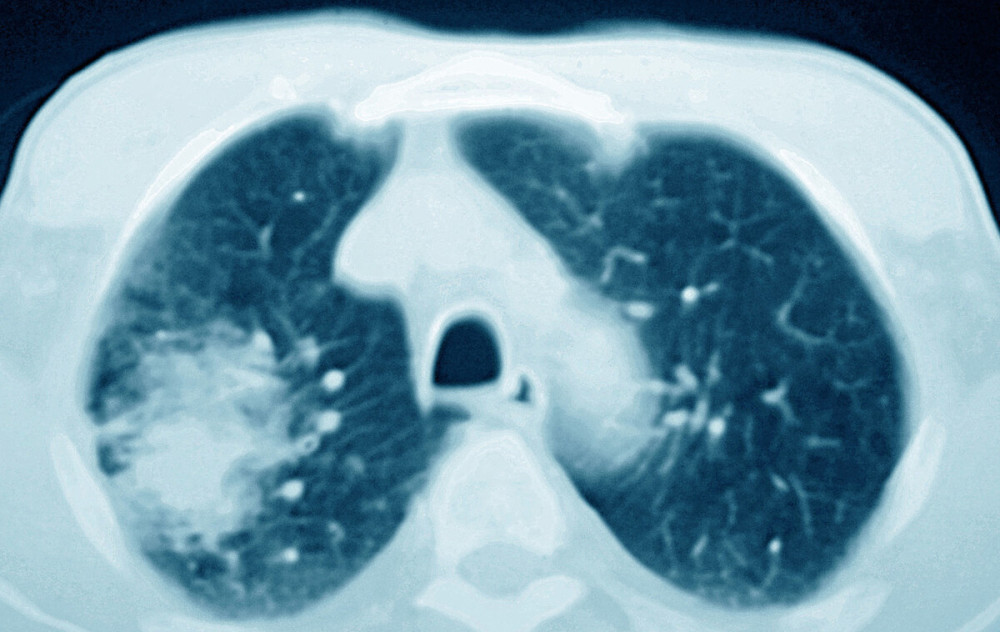 男女肺癌筛查方法同为低剂量ct,而男女肺癌死亡发病比却大不同