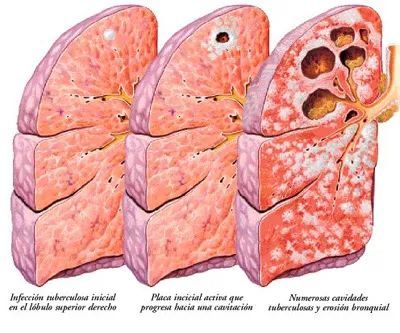 肺结核只是细菌感染吗小心这种肺结核有可能会继发慢阻肺