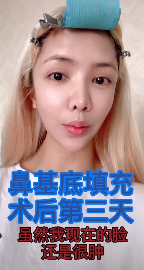 李小璐闺蜜鼻基底填充整容,撞脸王思聪前任豆得儿,捂嘴不敢笑怕脸崩