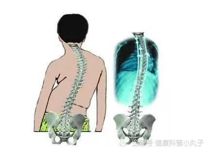 脊柱侧弯真的伤不起听赵林成都附大脊柱侧弯矫正中心医生说为什么