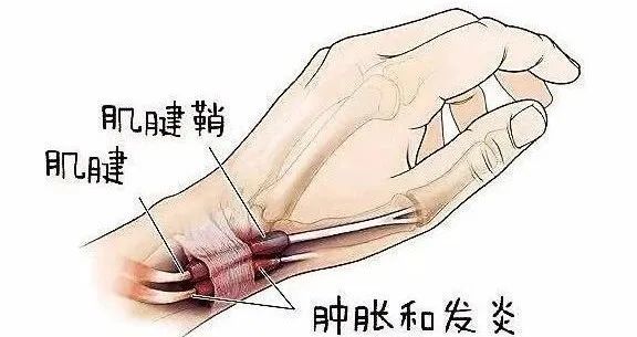 人均腱鞘炎_手腕腱鞘炎图片(2)