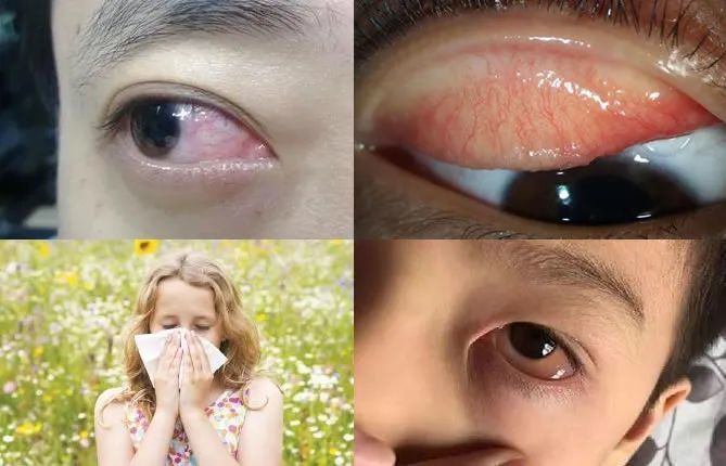 眼睛"痒死了",过敏性结膜炎如何治疗和预防?
