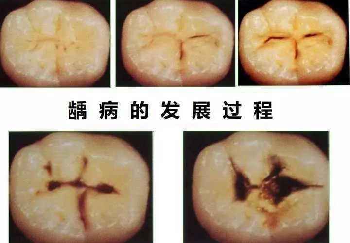 牙龈出血90%的东莞市民都会忽略的问题