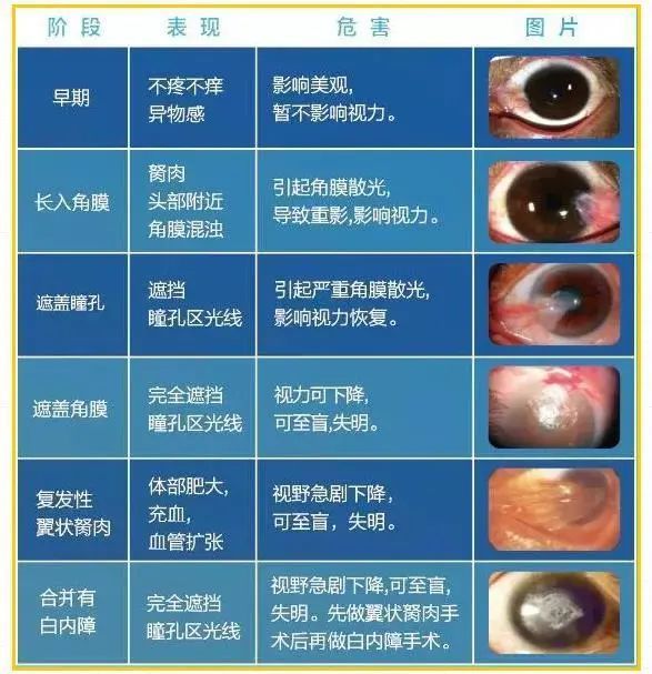 眼睛里长了一点像瘦肉的东西是什么?可能是被忽视的慢性眼疾杀手!