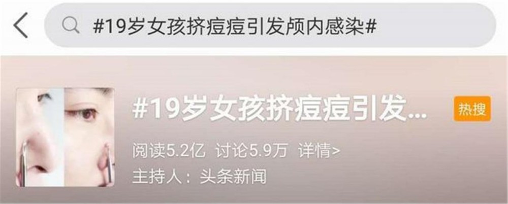 "危险三角区"的痘痘千万不能挤!有人挤了一下,结果留下后遗症