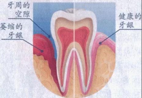 牙龈萎缩分为病理性萎缩和生理性萎缩两类,病理性萎缩主要是龈缘部分