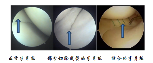 薇娅做半月板手术上热搜!这种病为何年轻人高发