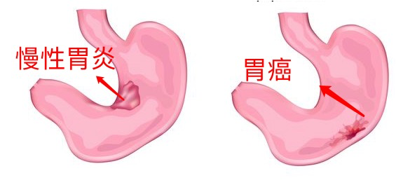 外阴长了一个硬疙瘩怎么回事（外阴长了一个硬疙瘩怎么回事痒）