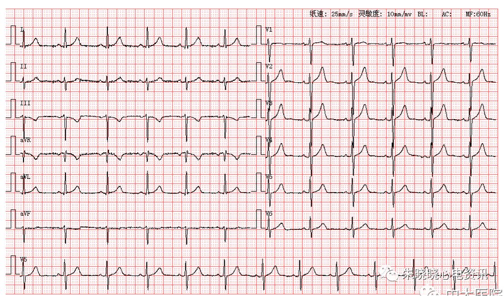 患者男,53岁,图为其正常体检心电图