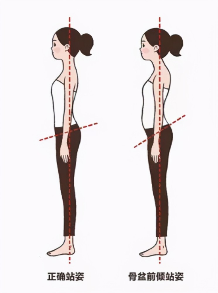 矫正骨盆前倾前移4个动作让您重回优雅姿态