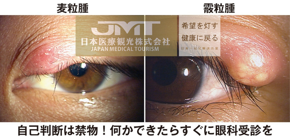 jmt日本医疗-麦粒肿和霰粒肿外观虽相似但治疗方法完全不同