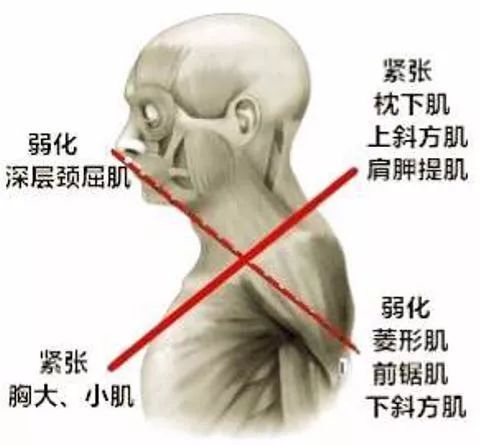 "圆肩驼背头前引"最全矫正指南,人人都用得上