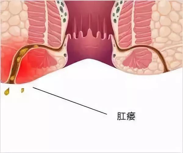 肛瘘不治疗能自己愈合么?|直肠|肛瘘|肛周脓肿|肛门