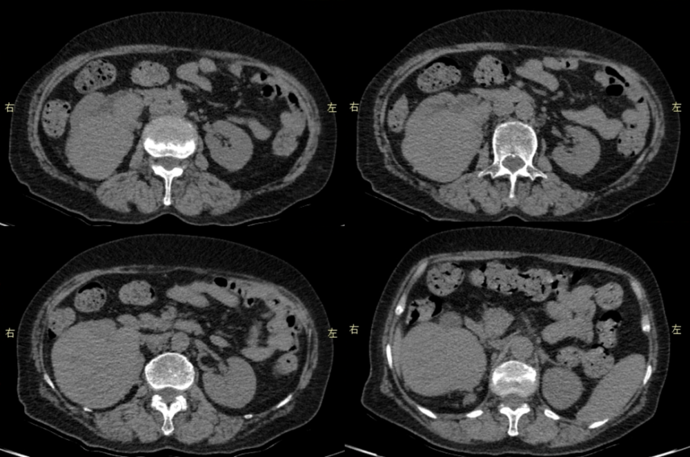 影像时间 病例展示 患者:女性,72 岁 主诉:右侧腰部隐痛,血尿一周余