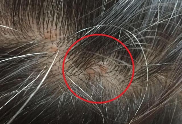 藏在头发里硬硬的"小包包"是什么?早了解早受益!