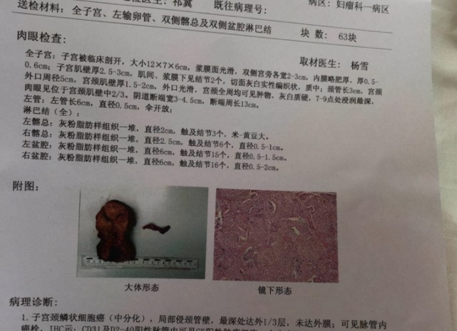 42岁大姐腹痛查出宫颈癌,医生摇头:3事不注意,会"拖垮