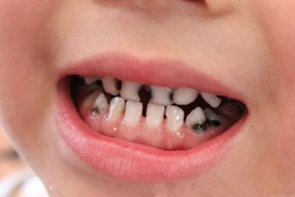 但乳牙龋坏严重的话, 会影响到牙体的生长,引发牙釉质发育不良
