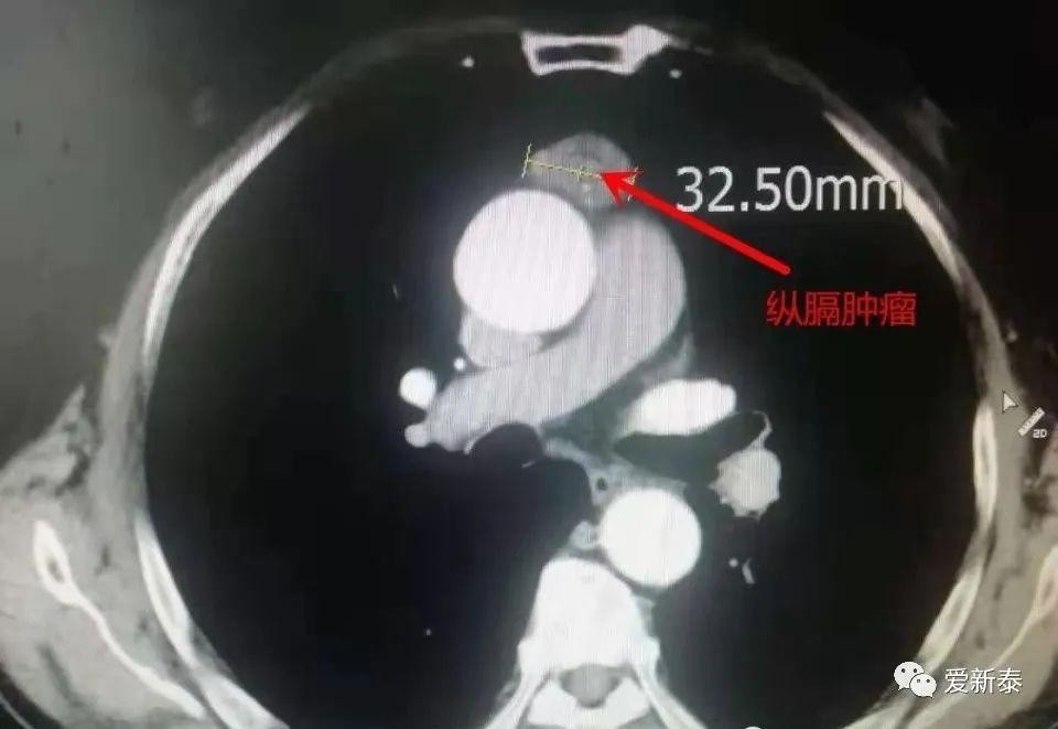 新泰市第二人民医院成功开展首例经剑突下入路前纵隔肿瘤切除术
