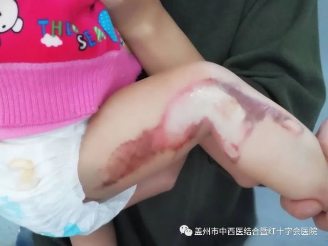 患儿女,11个月大,不慎因开水烫伤右腿右脚面,左脚后跟,受伤后第一
