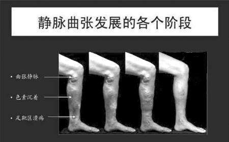 避免下肢静脉曲张发生要注意哪些方面预防