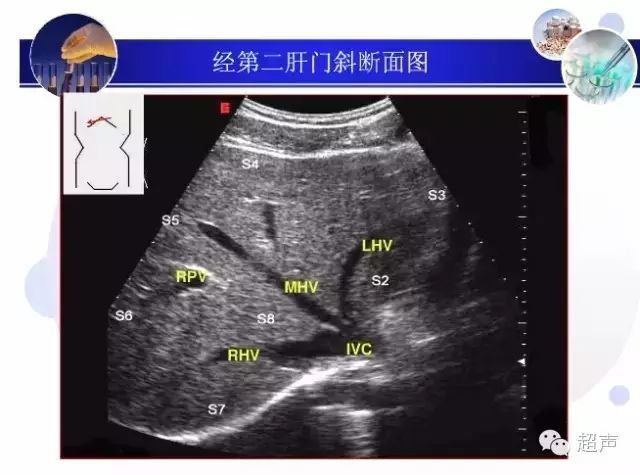 肝脏超声分段