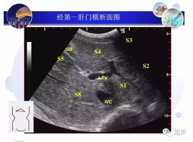 肝脏超声分段