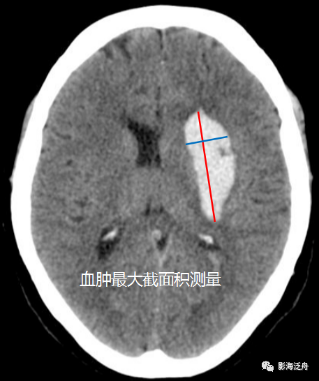 2.硬膜外血肿体积测量
