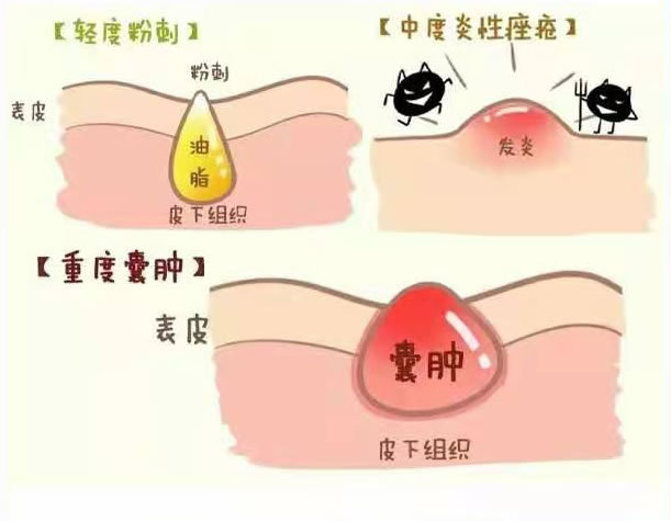 中度痤疮:刚冒头的小痘痘,呈粉红色,轻微炎症阶段,勤用敷料,注意肌肤