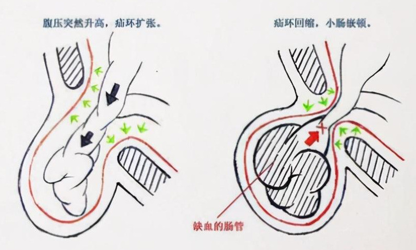 可能是疝气在作怪!教你4步早预防